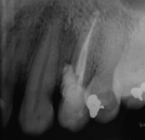 Selamento de perfuração com MTA